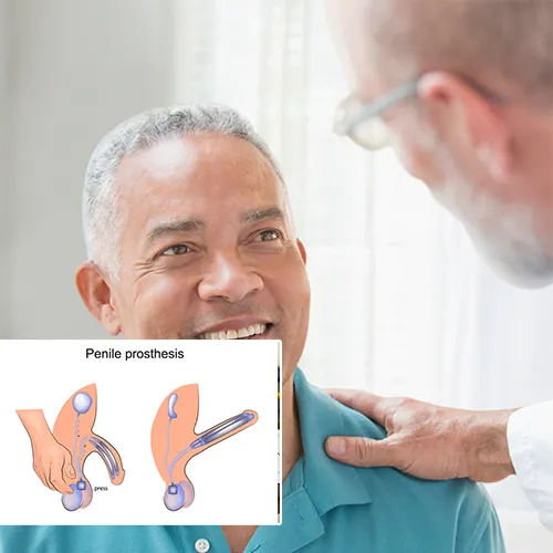 Why Choose Urology Surgery Center 



 for Your Penile Implant